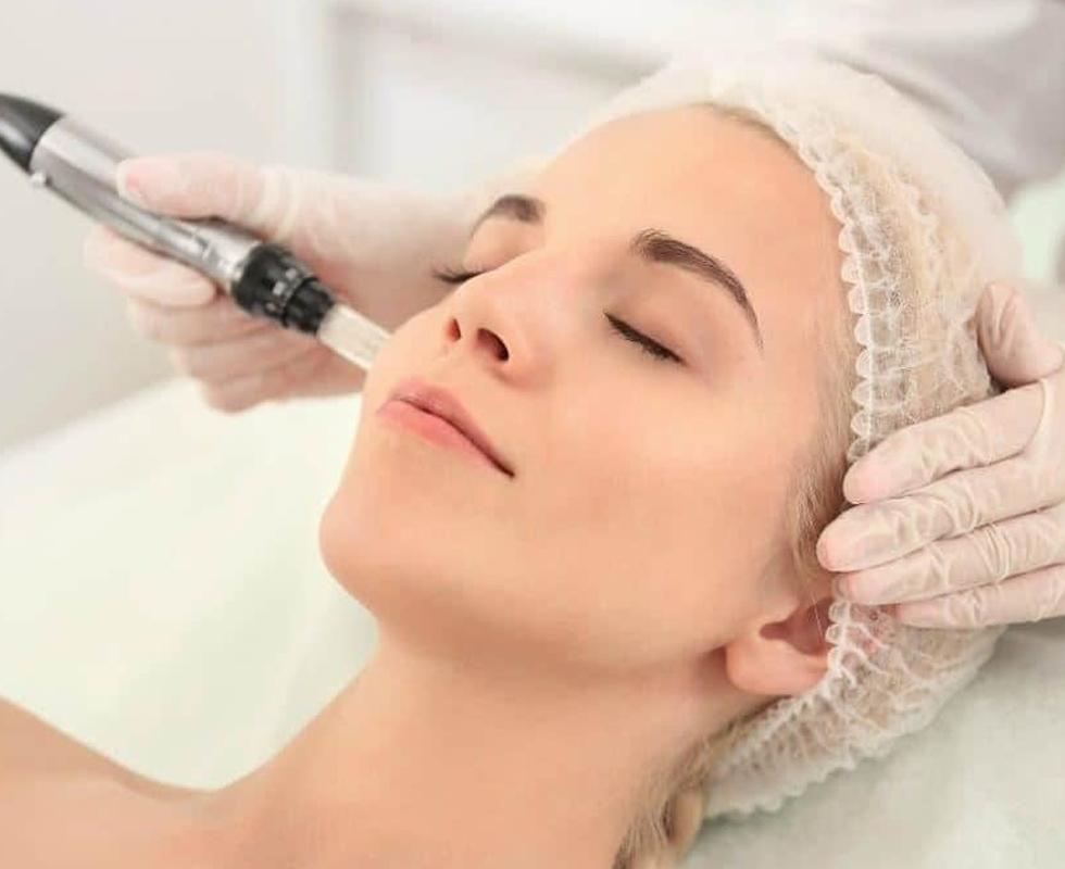 microneedling